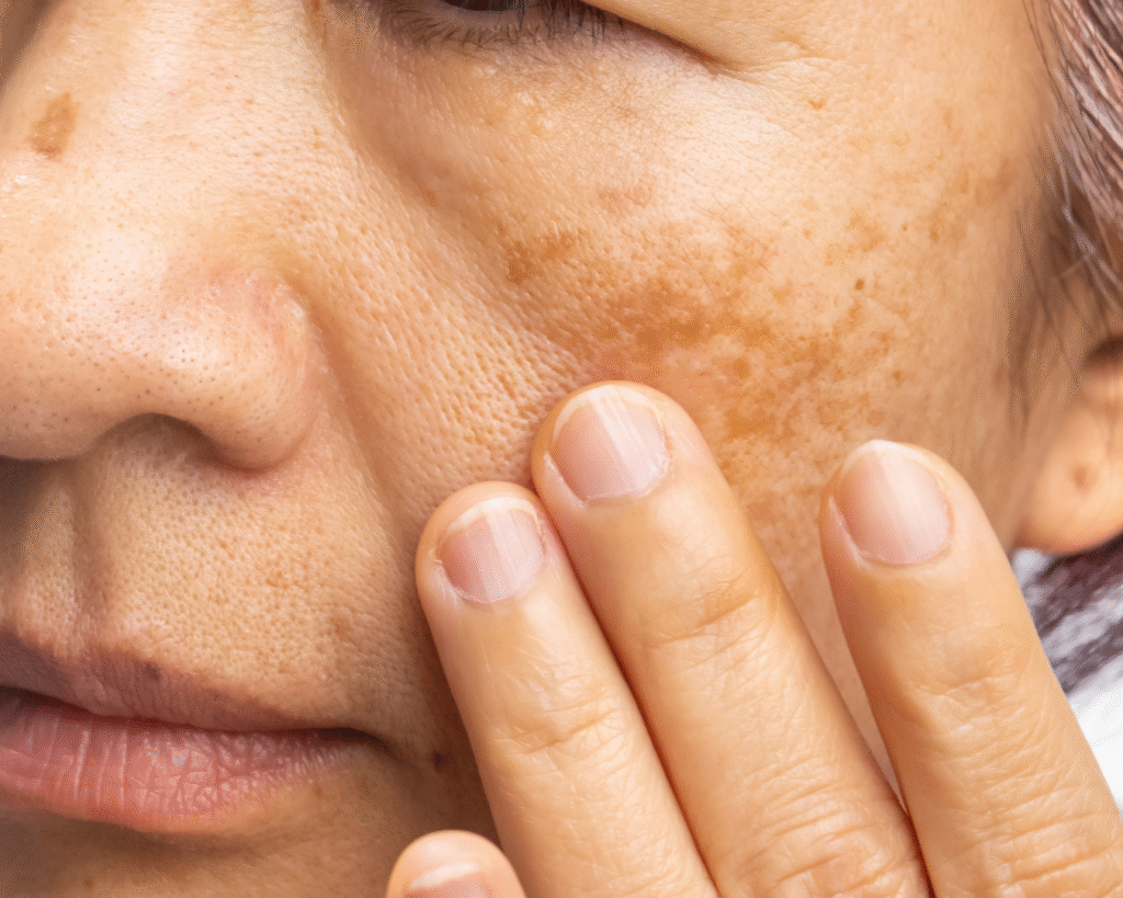 Microinfusão de Medicamentos na Pele para melasma