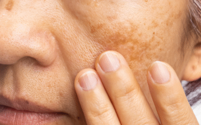 MMP para melasma: clareadores eficazes na derme