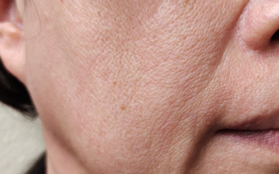 Flacidez no rosto: como escolher o tratamento dermatológico mais eficaz