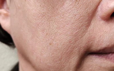Flacidez no rosto: como escolher o tratamento dermatológico mais eficaz